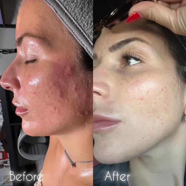 Acne Bootcamp Membership